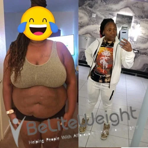 Weight Loss Surgery Gastric Sleeve before and after