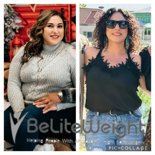 Weight Loss Surgery Gastric Sleeve before and after