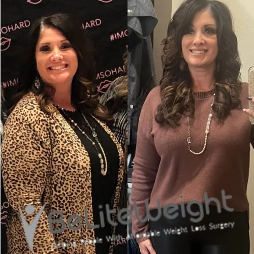 Weight Loss Surgery Gastric Sleeve before and after