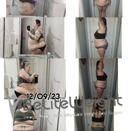 Weight Loss Surgery Gastric Sleeve before and after
