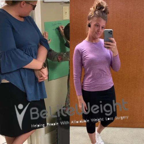Weight Loss Surgery Gastric Sleeve before and after