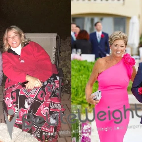 Weight Loss Surgery Before And After