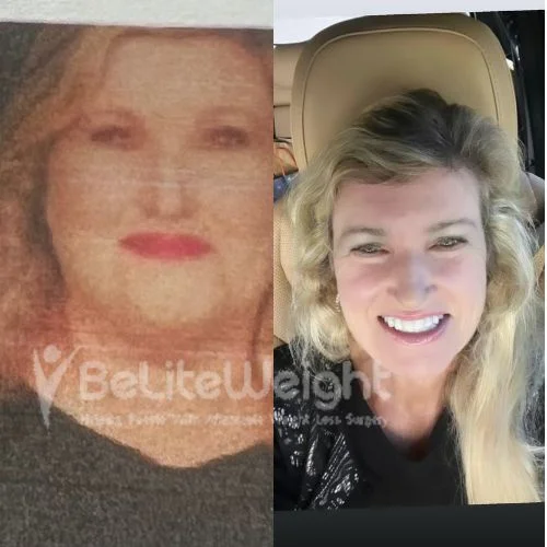 Janice C-  Gastric bypass revision 4 years update*