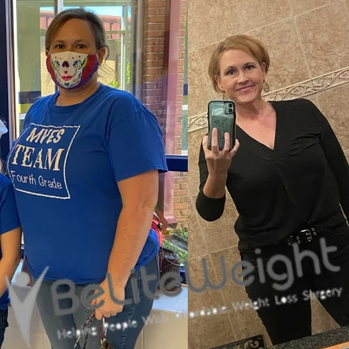 Weight Loss Surgery Gastric Sleeve before and after