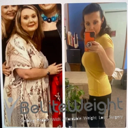 Weight Loss Surgery Before And After