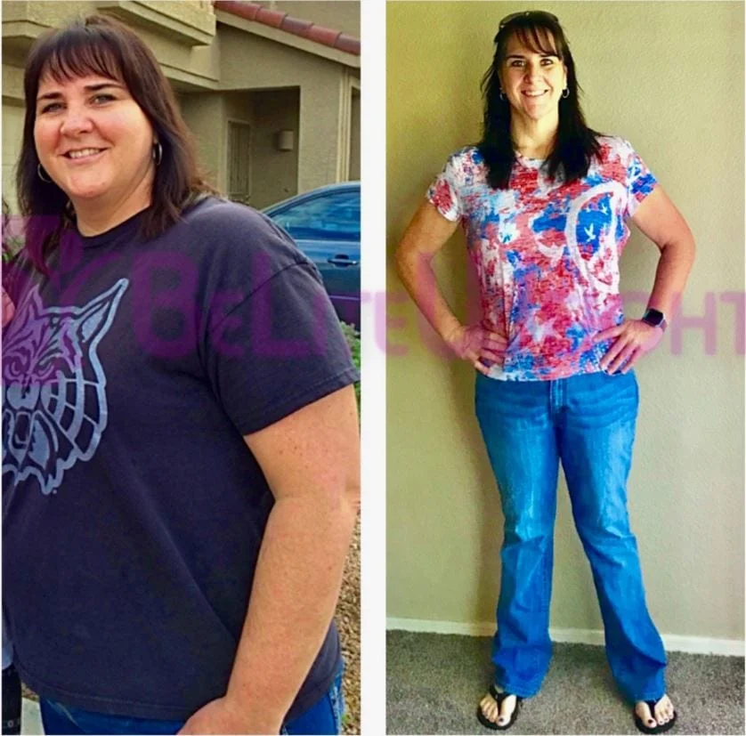 Weight Loss Surgery before and after Patient - Surgeon Dr. Jose RodriguezProcedure Gastric Sleeve *See Below