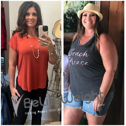 Weight Loss Surgery Gastric Sleeve before and after