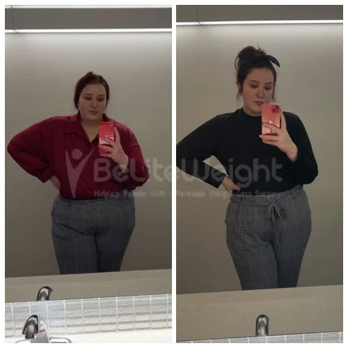 RNY Gastric Bypass before and after Patient - Everything is going great! No issues at all at this point. I'm down 90 pounds!RNY Gastric...