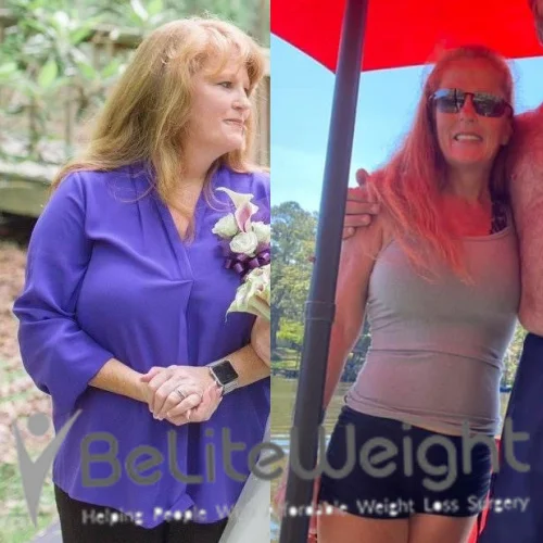 Weight Loss Surgery Before And After