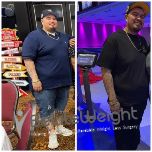 Weight Loss Surgery Gastric Sleeve before and after