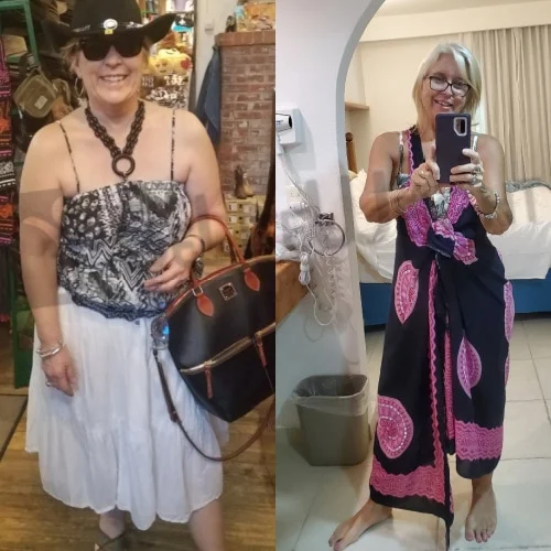 Weight Loss Surgery before and after Patient - It's been 2 years since my surgery and I'm maintaining my weight loss off approx...
