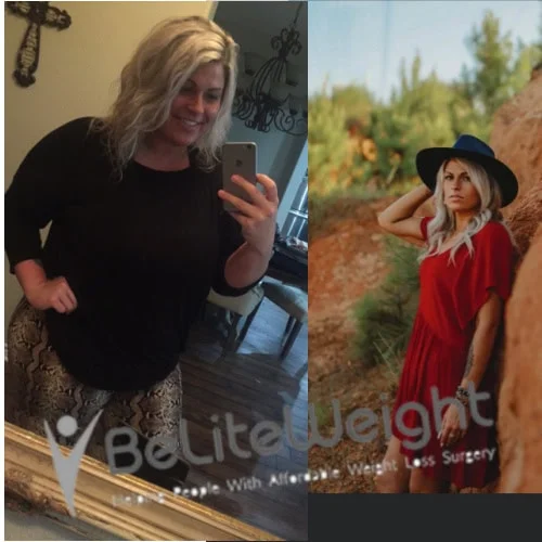 Weight Loss Surgery Gastric Sleeve before and after