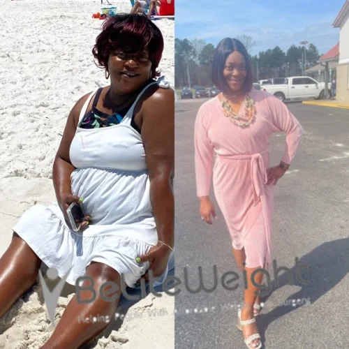 Weight Loss Surgery Gastric Sleeve before and after