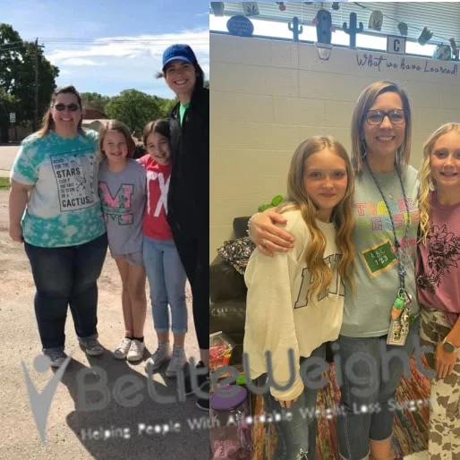 Weight Loss Surgery Before And After