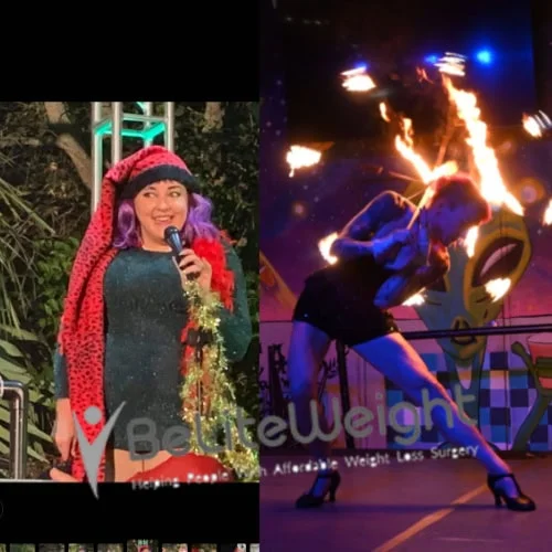 Weight Loss Surgery Gastric Sleeve before and after