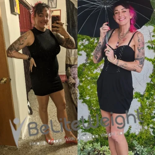 Weight Loss Surgery Before And After