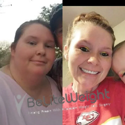 Weight Loss Surgery Gastric Sleeve before and after