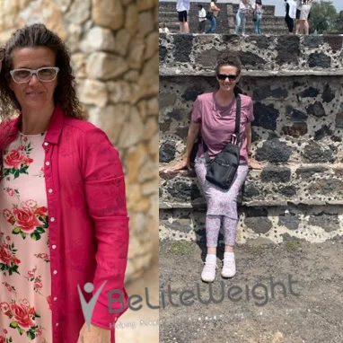 Weight Loss Surgery Gastric Sleeve before and after