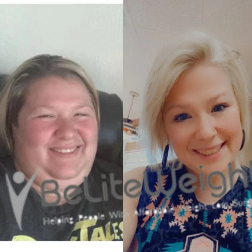 Weight Loss Surgery Before And After