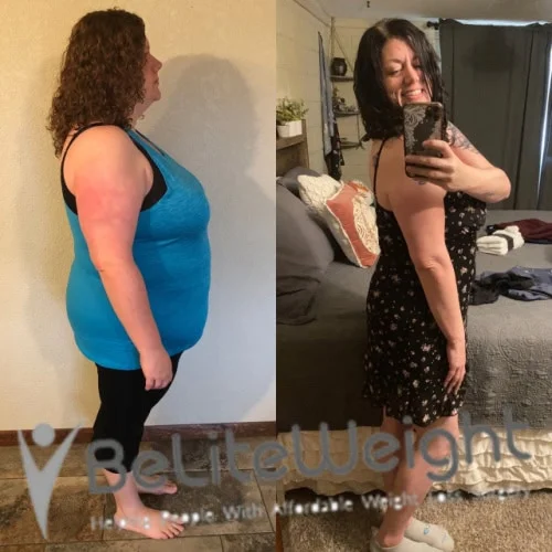 Weight Loss Surgery Gastric Sleeve before and after