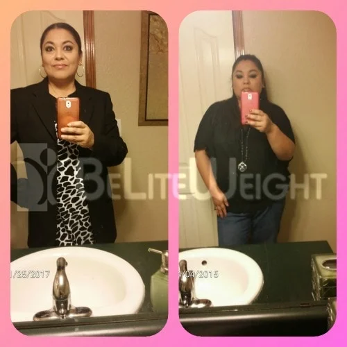 Weight Loss Surgery before and after Patient - Surgeon Dr. Jose RodriguezProcedure Metabolic Mini Bypass Thank you Be Lite Weight for changing my life!!! *See...