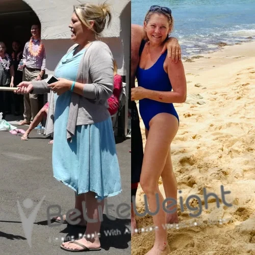 Weight Loss Surgery Gastric Sleeve before and after