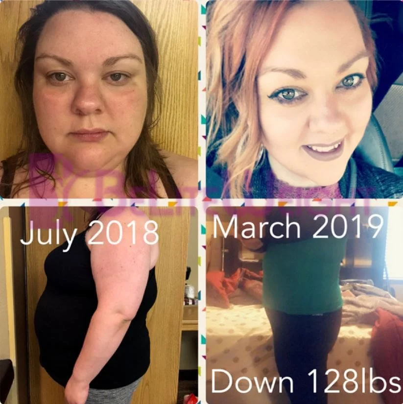 Weight Loss Surgery before and after Patient - Surgeon Dr. Jose RodriguezProcedure Mini Gastric Bypass *See Below