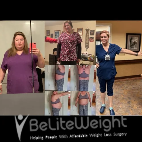 Weight Loss Surgery Gastric Sleeve before and after