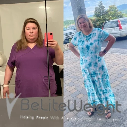 Weight Loss Surgery Before And After
