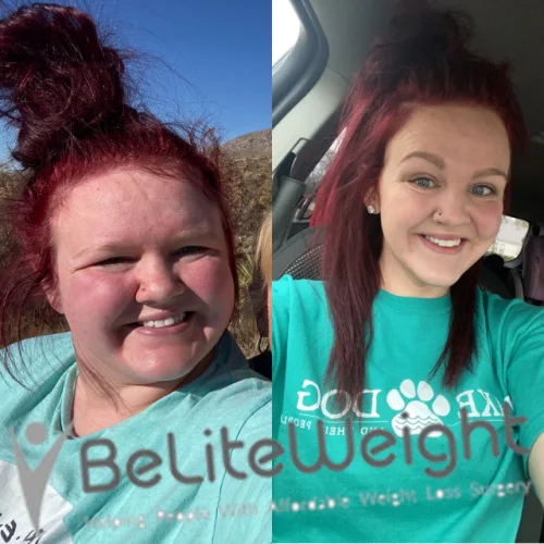 Weight Loss Surgery Before And After
