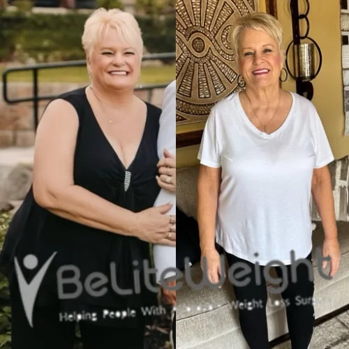 Weight Loss Surgery Gastric Sleeve before and after