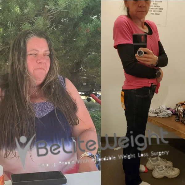 Weight Loss Surgery Gastric Sleeve before and after