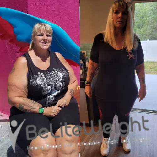 Weight Loss Surgery Before And After