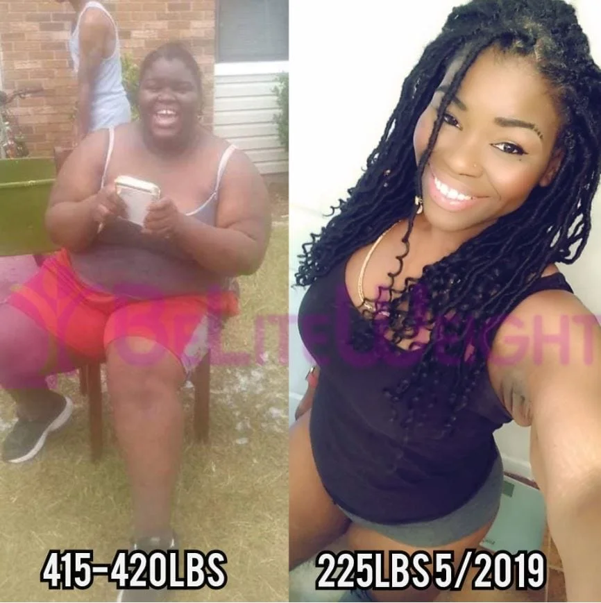 Weight Loss Surgery before and after Patient - Surgeon Dr. Jose RodriguezProcedure Gastric Sleeve *See Below