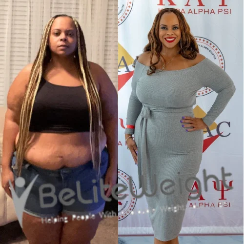 Weight Loss Surgery Gastric Sleeve before and after
