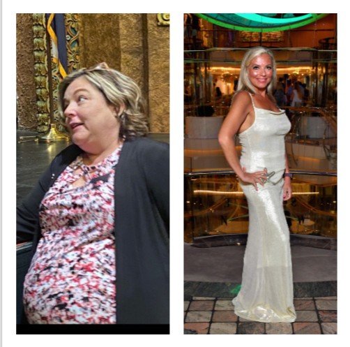 Mini Gastric Bypass before and after Patient - I'm doing great! I have lost 150 pounds. I have started a travel advisory business...