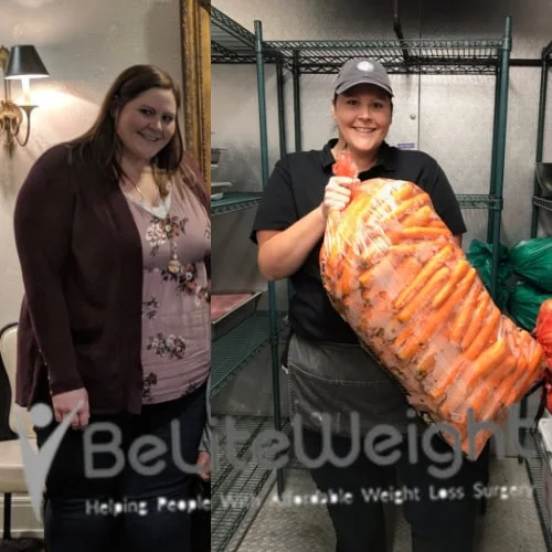 Weight Loss Surgery Before And After