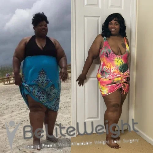Weight Loss Surgery Gastric Sleeve before and after