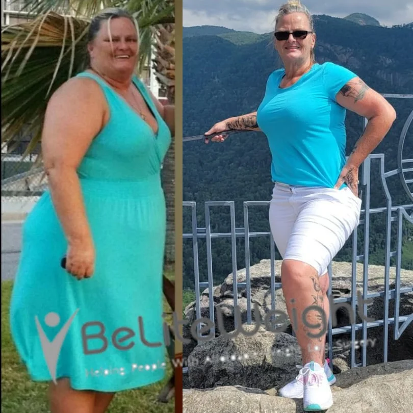 Weight Loss Surgery Gastric Sleeve before and after