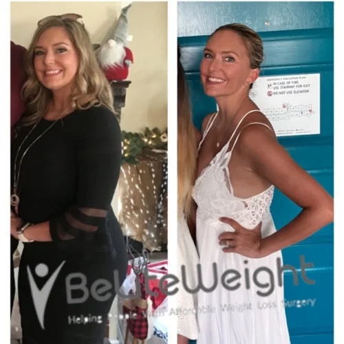 Weight Loss Surgery Before And After