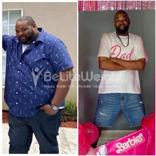 RNY Gastric Bypass before and after Patient - RNY Gastric BypassSurgeons: The surgical team of Dr. Jose Rodriguez-Villarreal, MD, FACS*See Below