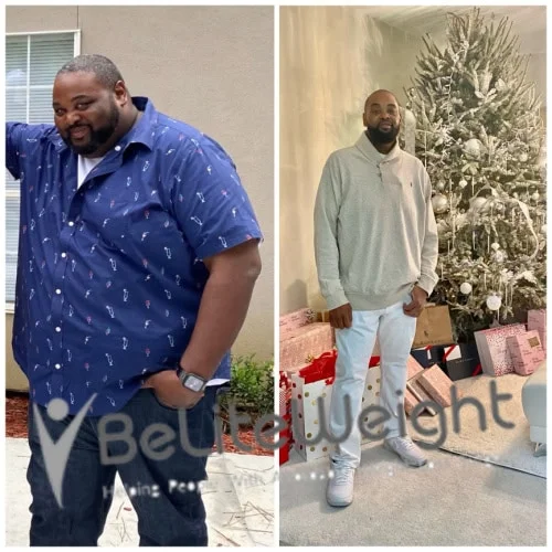 Weight Loss Surgery Before And After