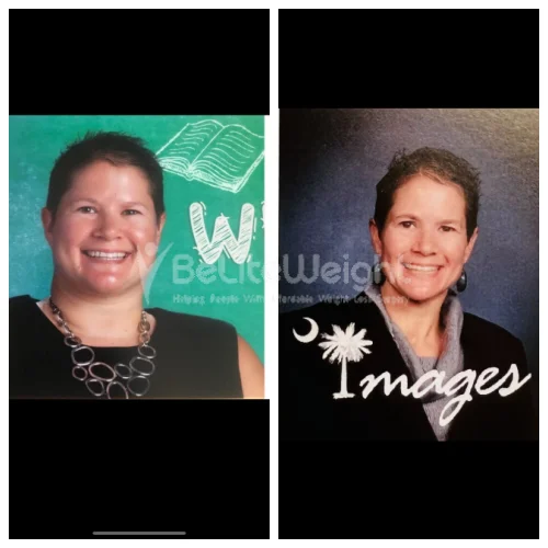 RNY Gastric Bypass before and after Patient - Hey JoAnne! My year has been nothing short of amazing!!! I have lost 79 pounds...