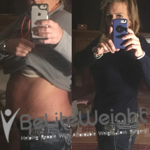 Weight Loss Surgery Gastric Sleeve before and after