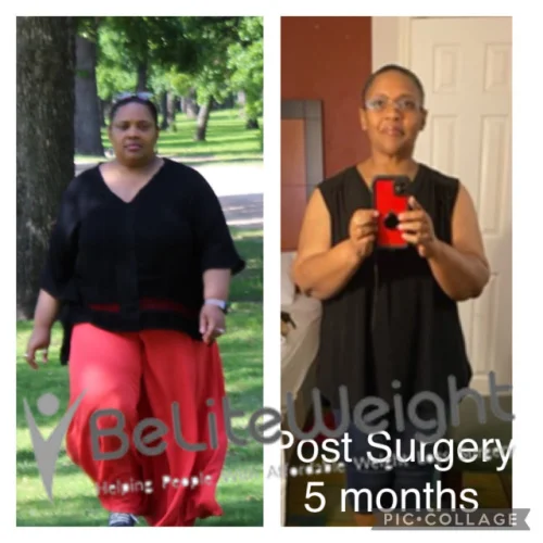 Weight Loss Surgery Gastric Sleeve before and after