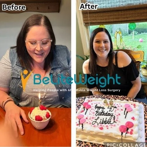 Weight Loss Surgery Before and After