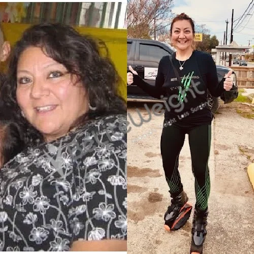 Weight Loss Surgery Gastric Sleeve before and after