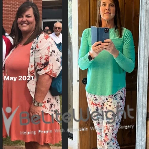 Weight Loss Surgery Gastric Sleeve before and after