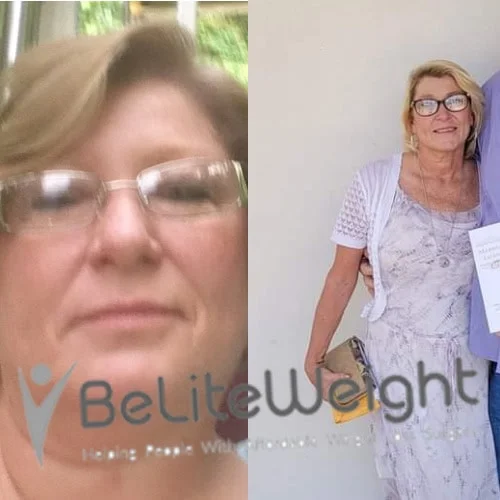 Weight Loss Surgery Before And After