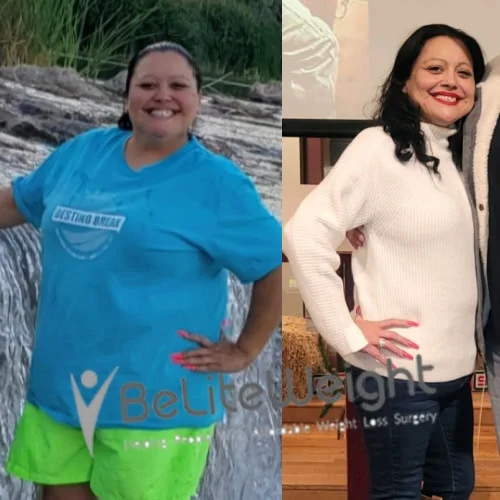 Weight Loss Surgery Gastric Sleeve before and after